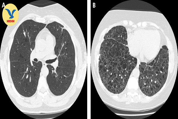 Phát hiện bệnh lý hiếm gặp ở phổi khi thăm khám tại Bệnh viện Đa khoa MEDLATEC